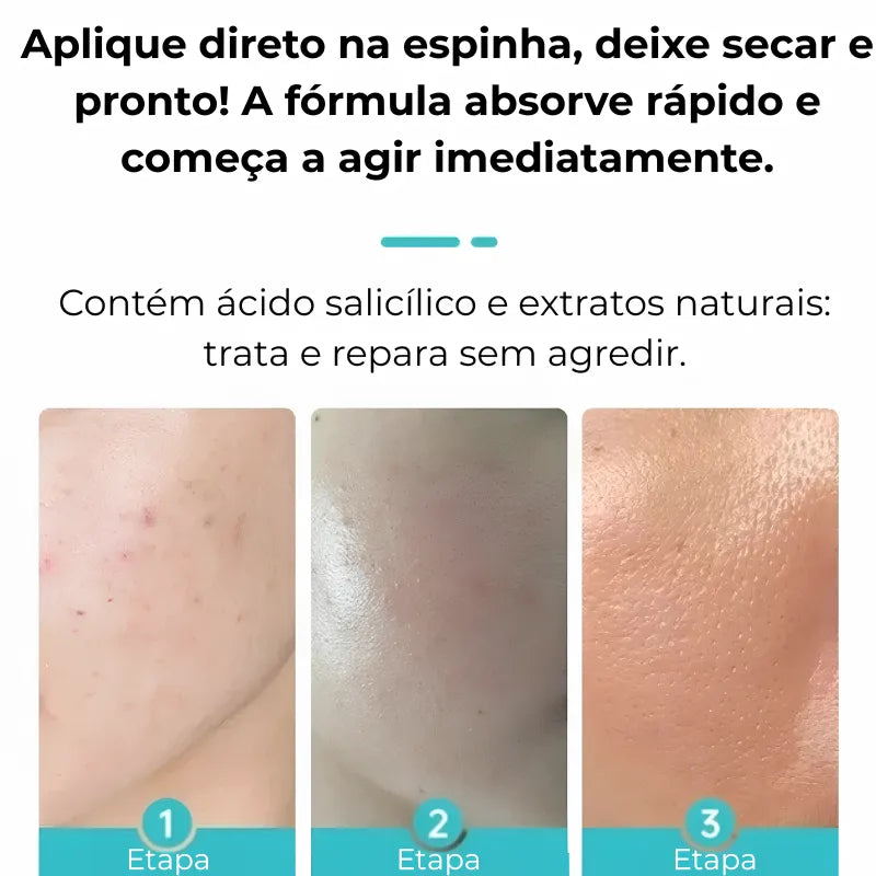 Secativo de Espinhas em Gel - Fórmula Asiática com Ácido Salicílico