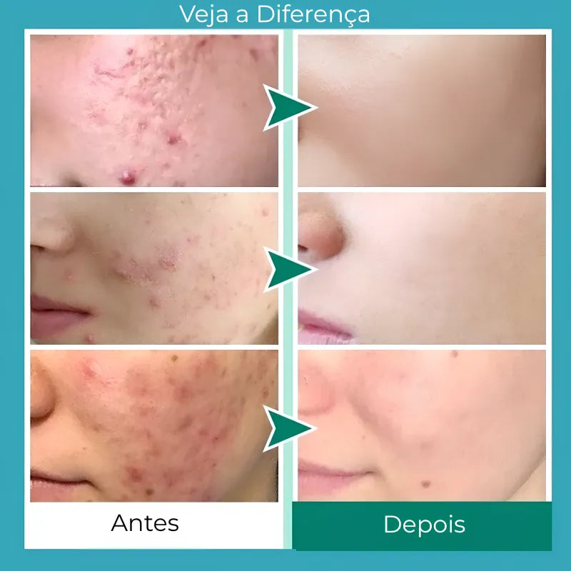 Secativo de Espinhas em Gel - Fórmula Asiática com Ácido Salicílico