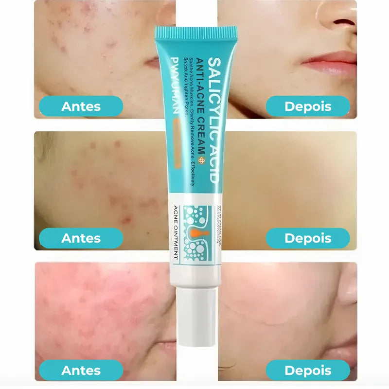 Secativo de Espinhas em Gel - Fórmula Asiática com Ácido Salicílico