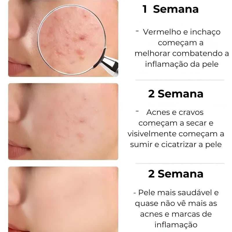 Secativo de Espinhas em Gel - Fórmula Asiática com Ácido Salicílico