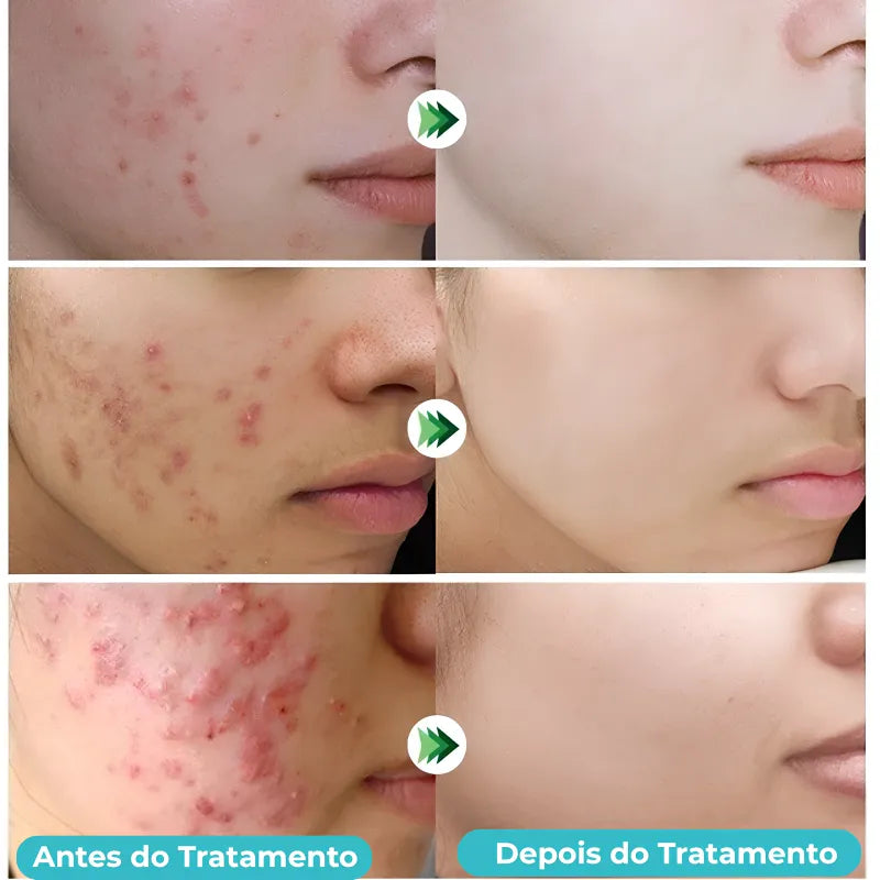 Secativo de Espinhas em Gel - Fórmula Asiática com Ácido Salicílico