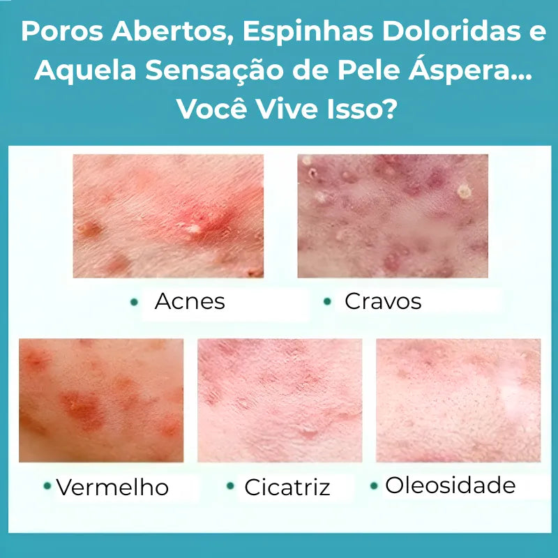 Secativo de Espinhas em Gel - Fórmula Asiática com Ácido Salicílico